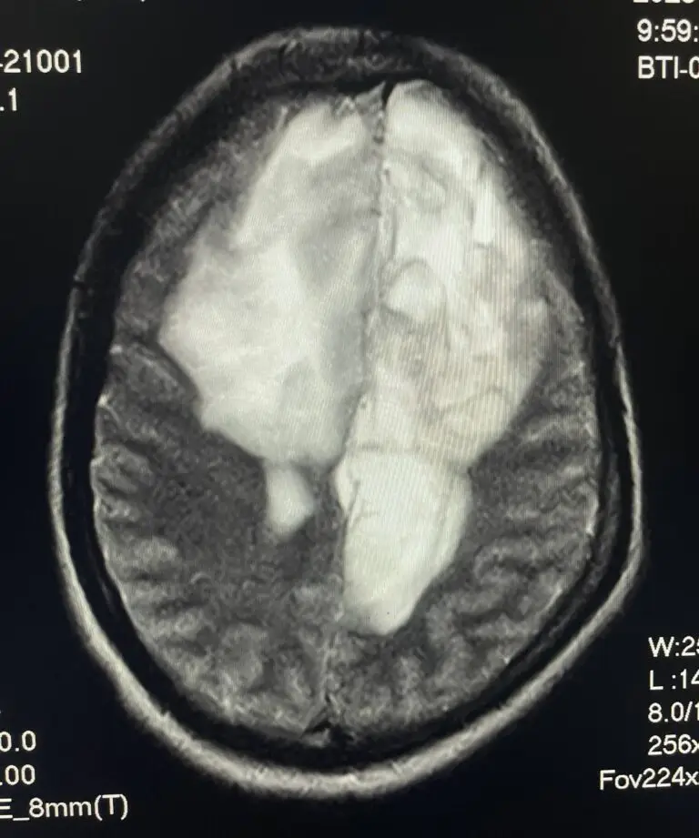 Primary Brain Tumors