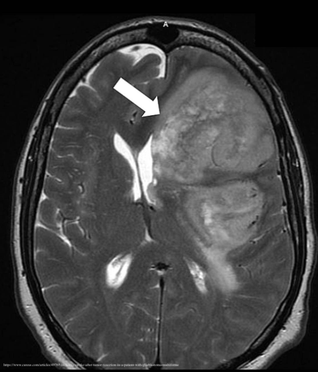 MRI scan showing cerebral edema and brain swelling in a patient