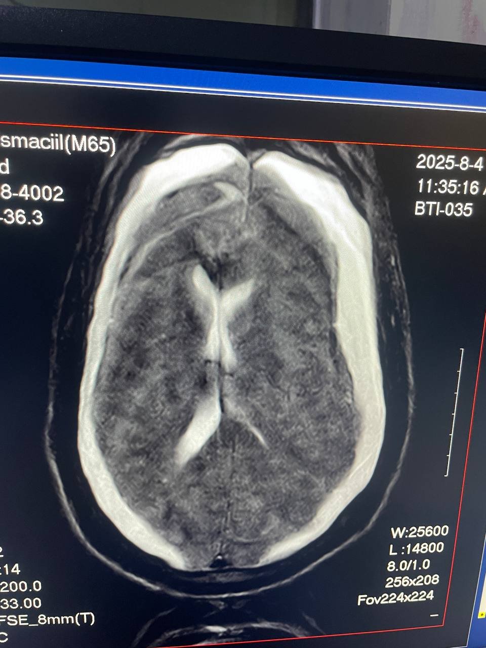 a 74-year-old patient diagnosed with bilateral chronic subdural hematomas with acute hemorrhagic components