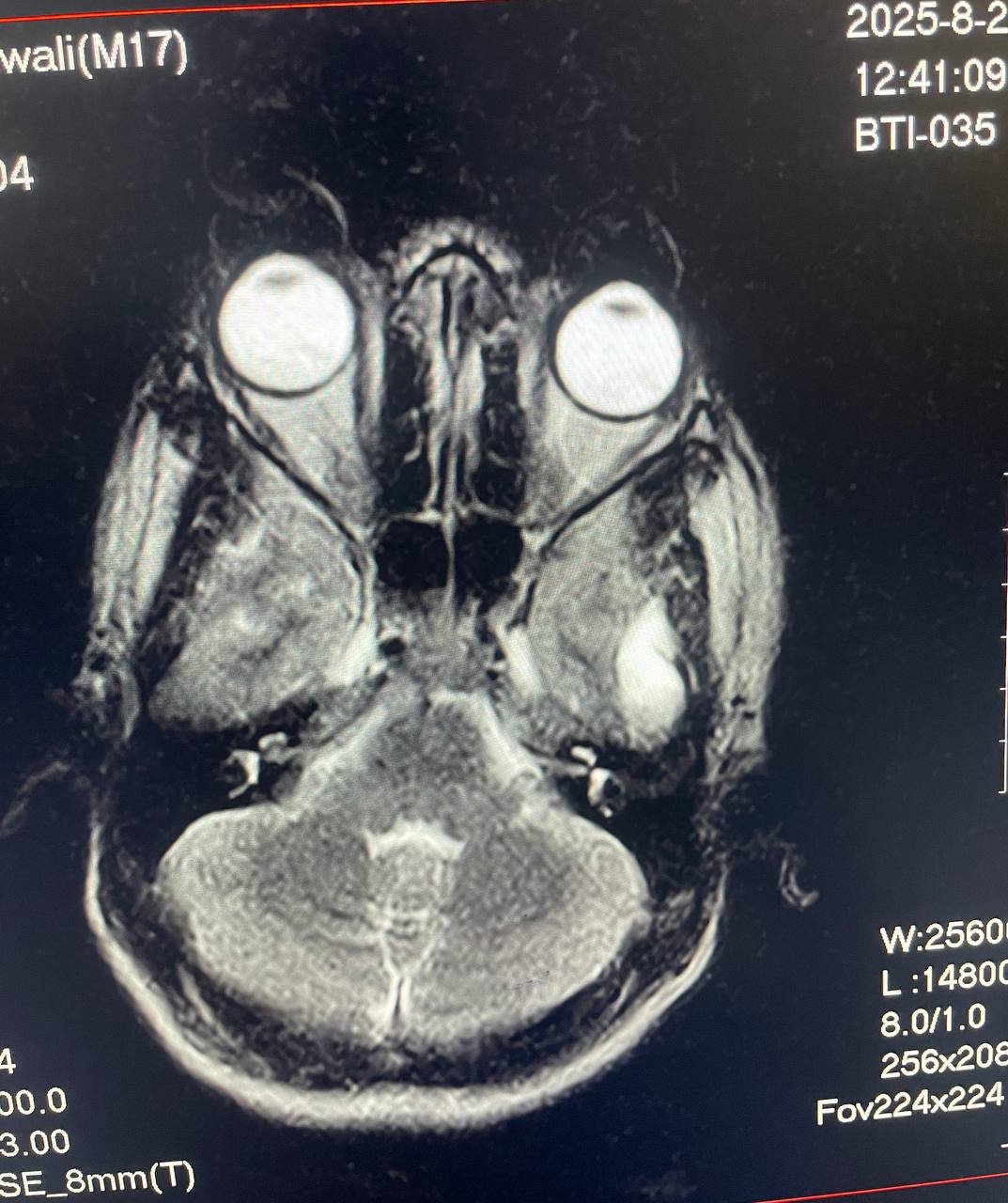 subdural hematoma